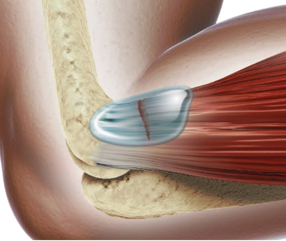 Infographic of a tear in a tendon covered witch sportvis