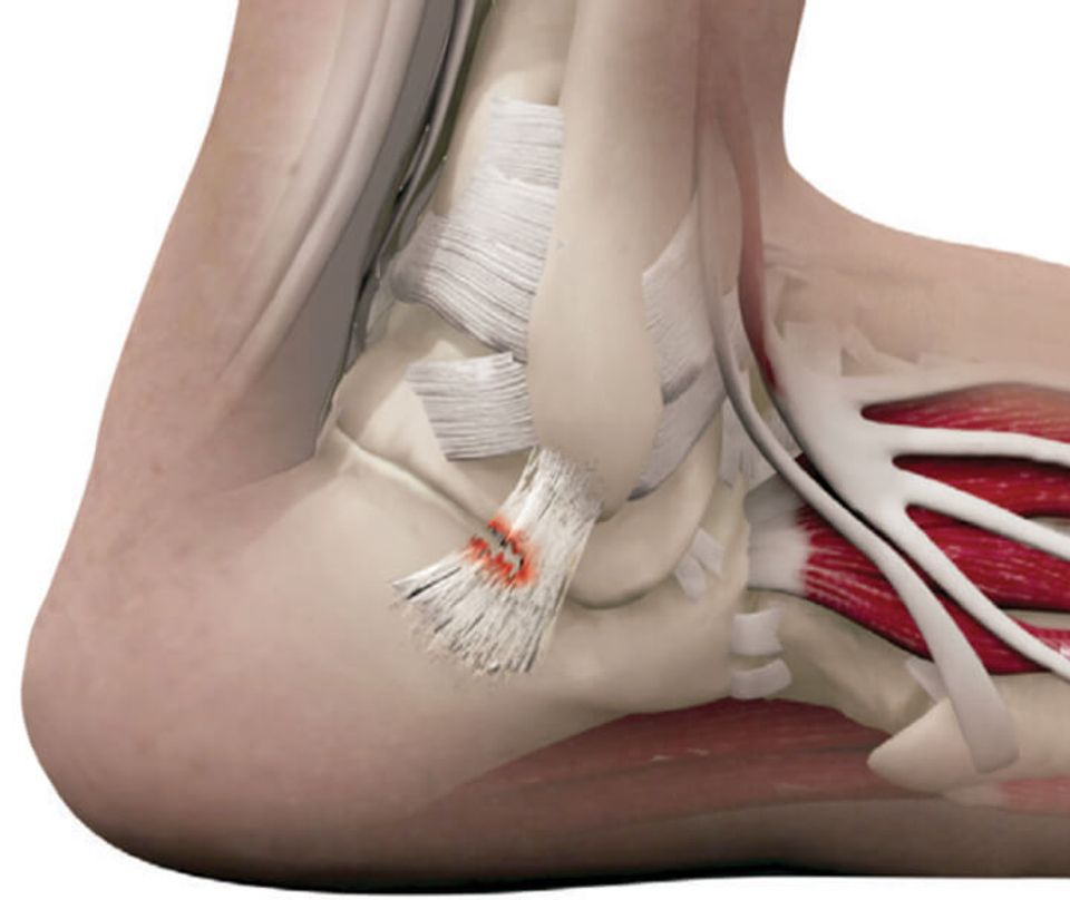 Infographic of a tear in a ankle